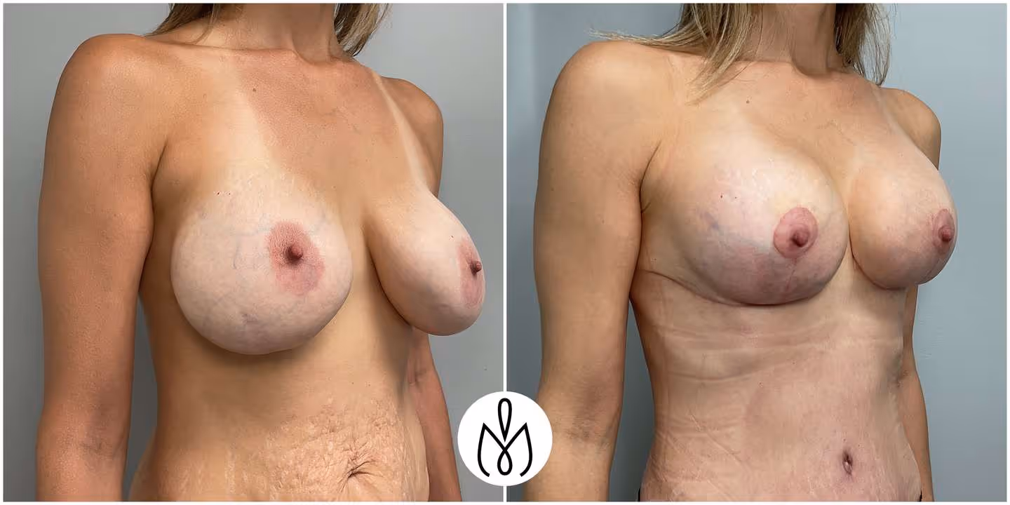 Before,After
