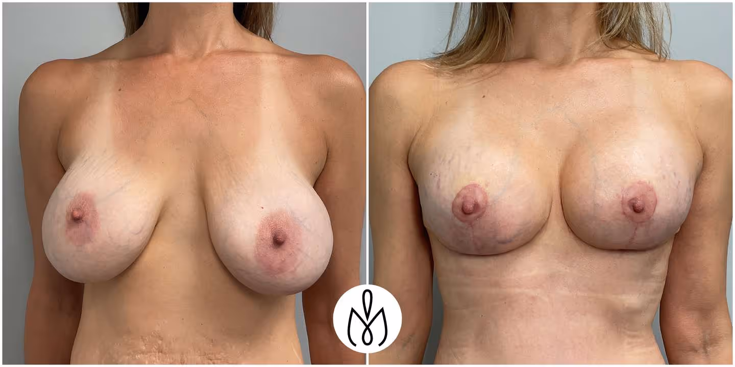 Before,After
