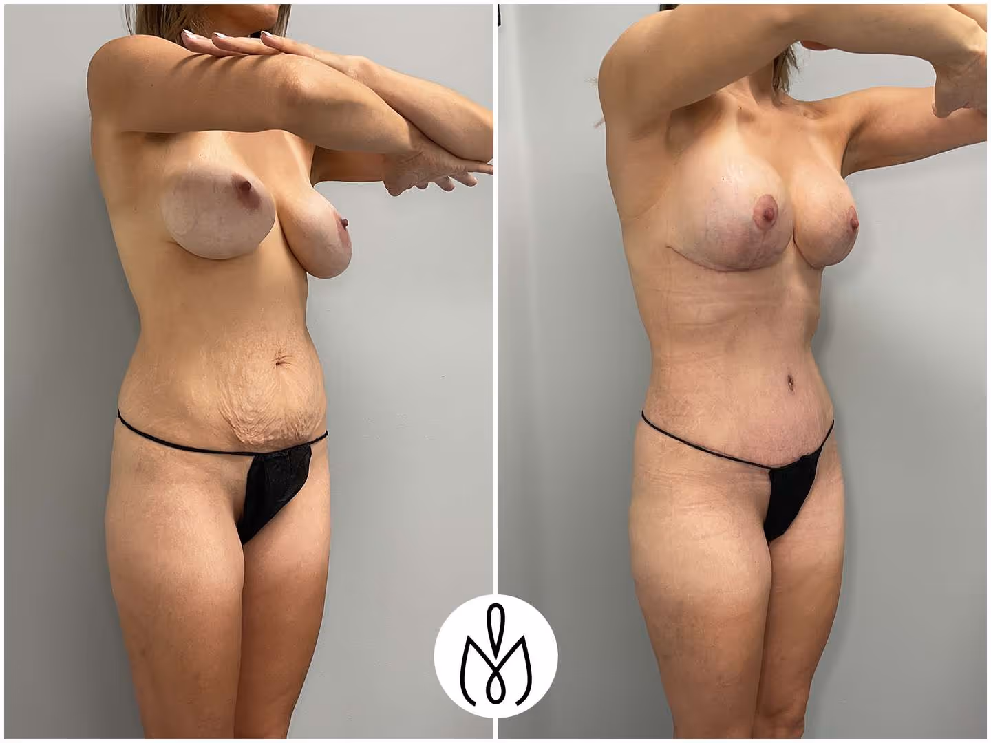 Before,After