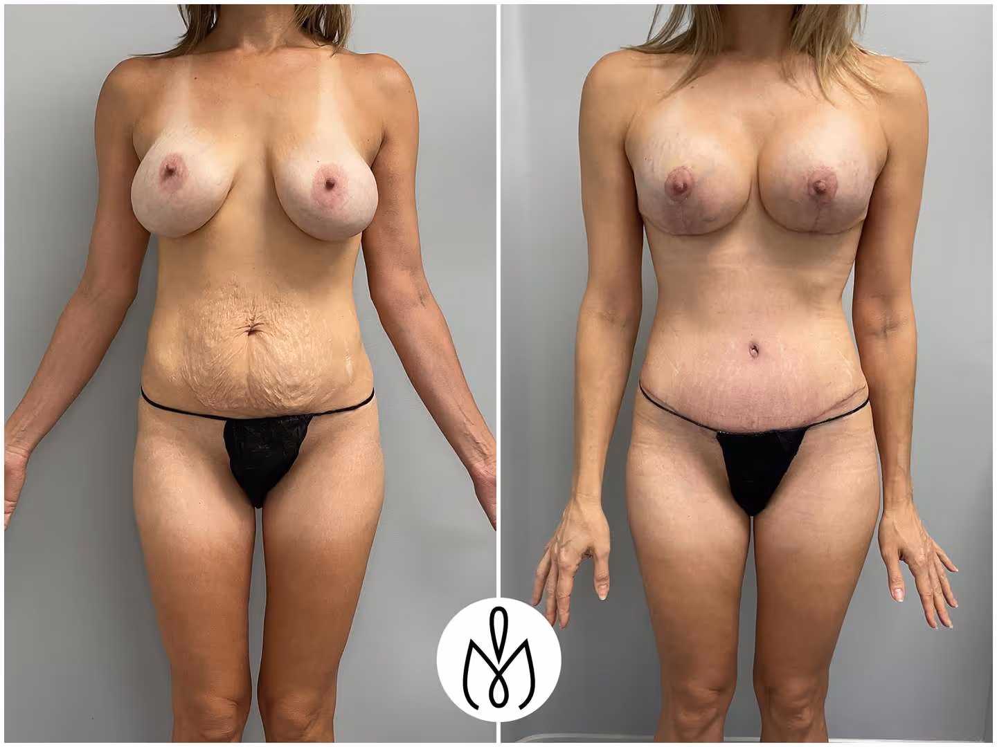 Before,After