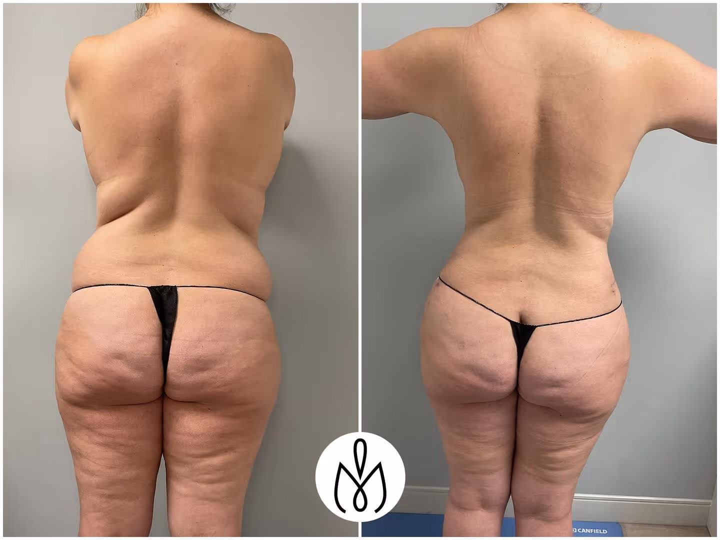 Before,After