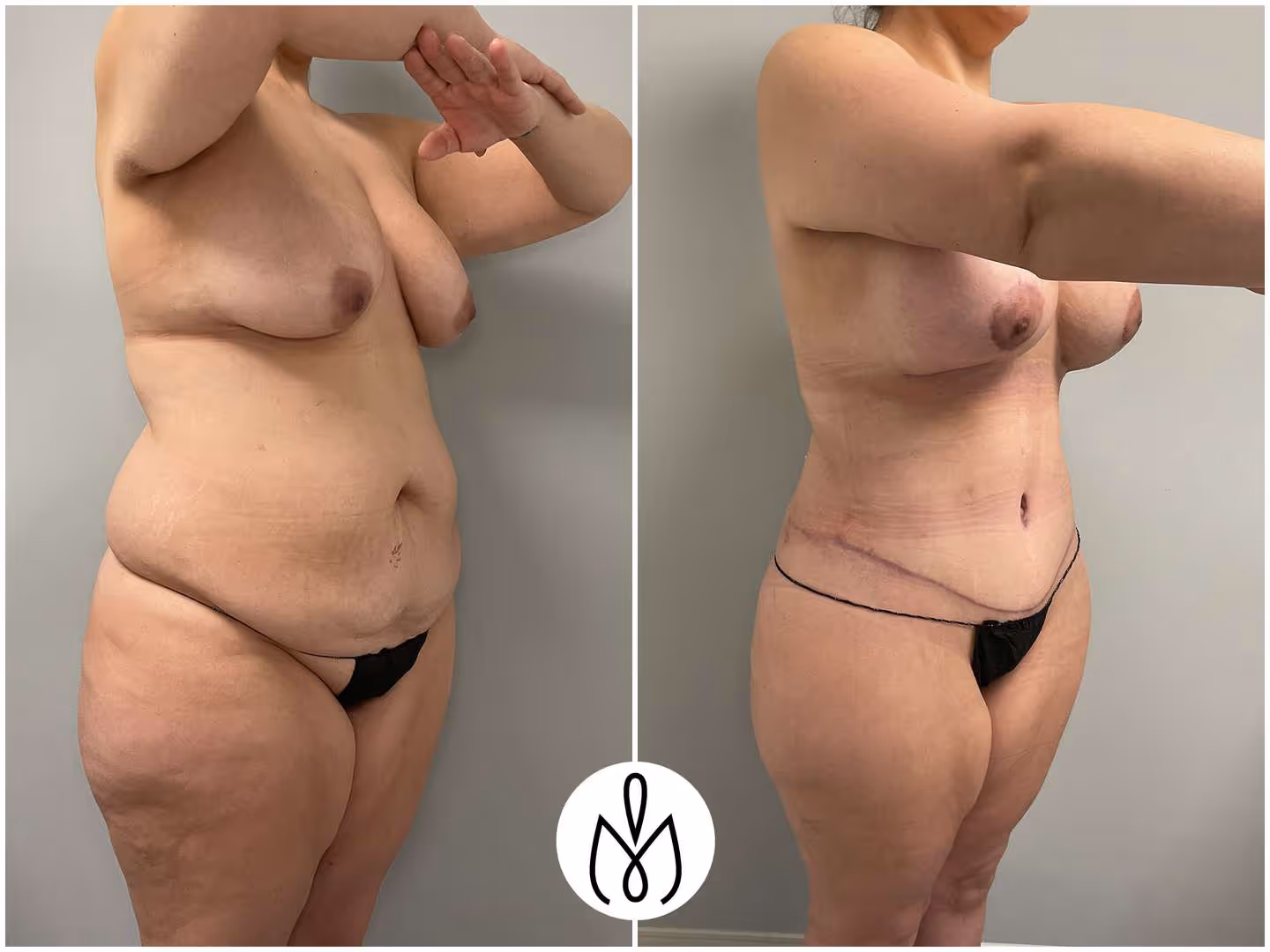 Before,After
