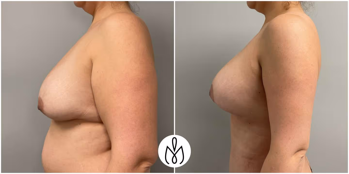 Before,After