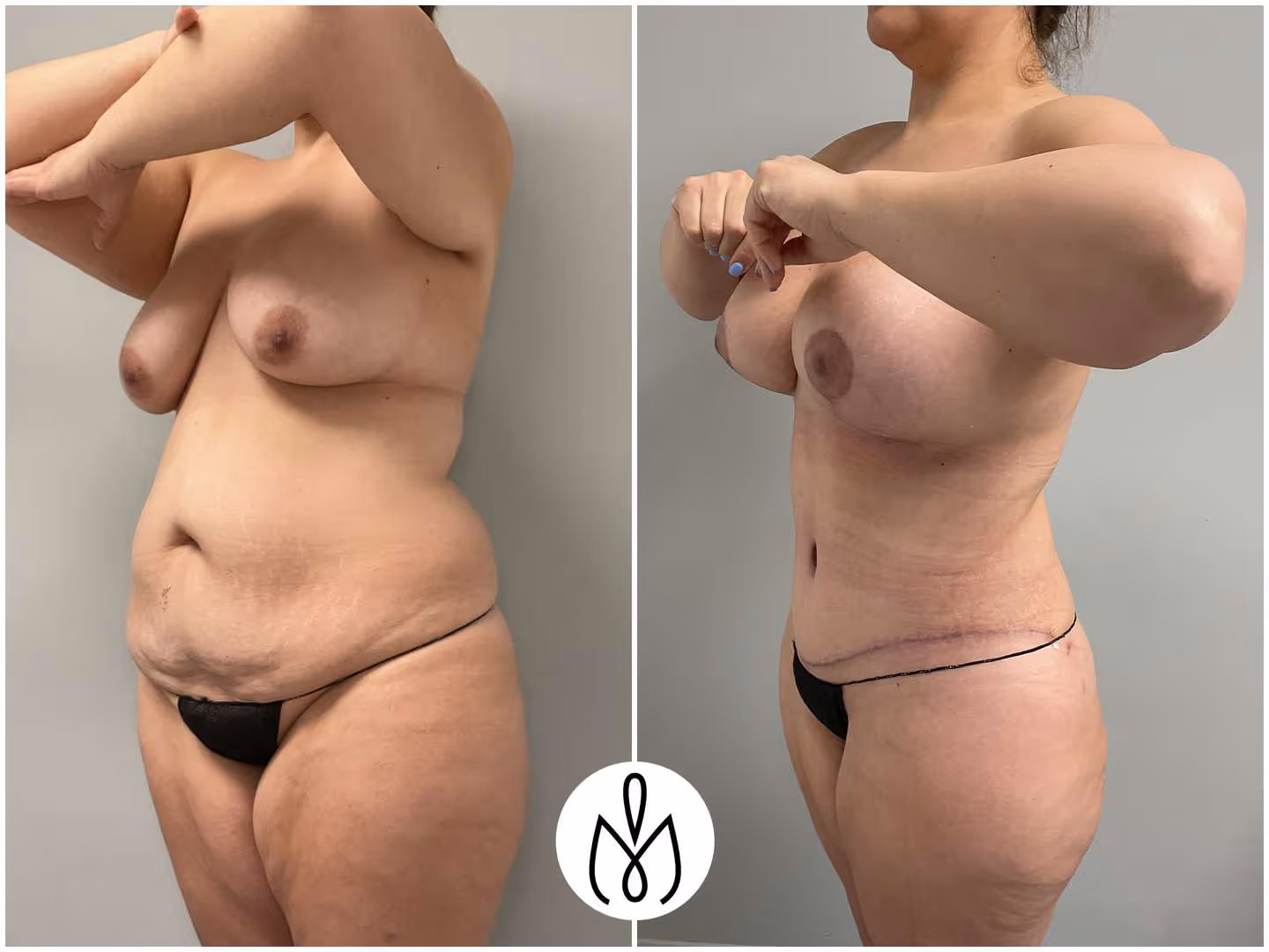 Before,After