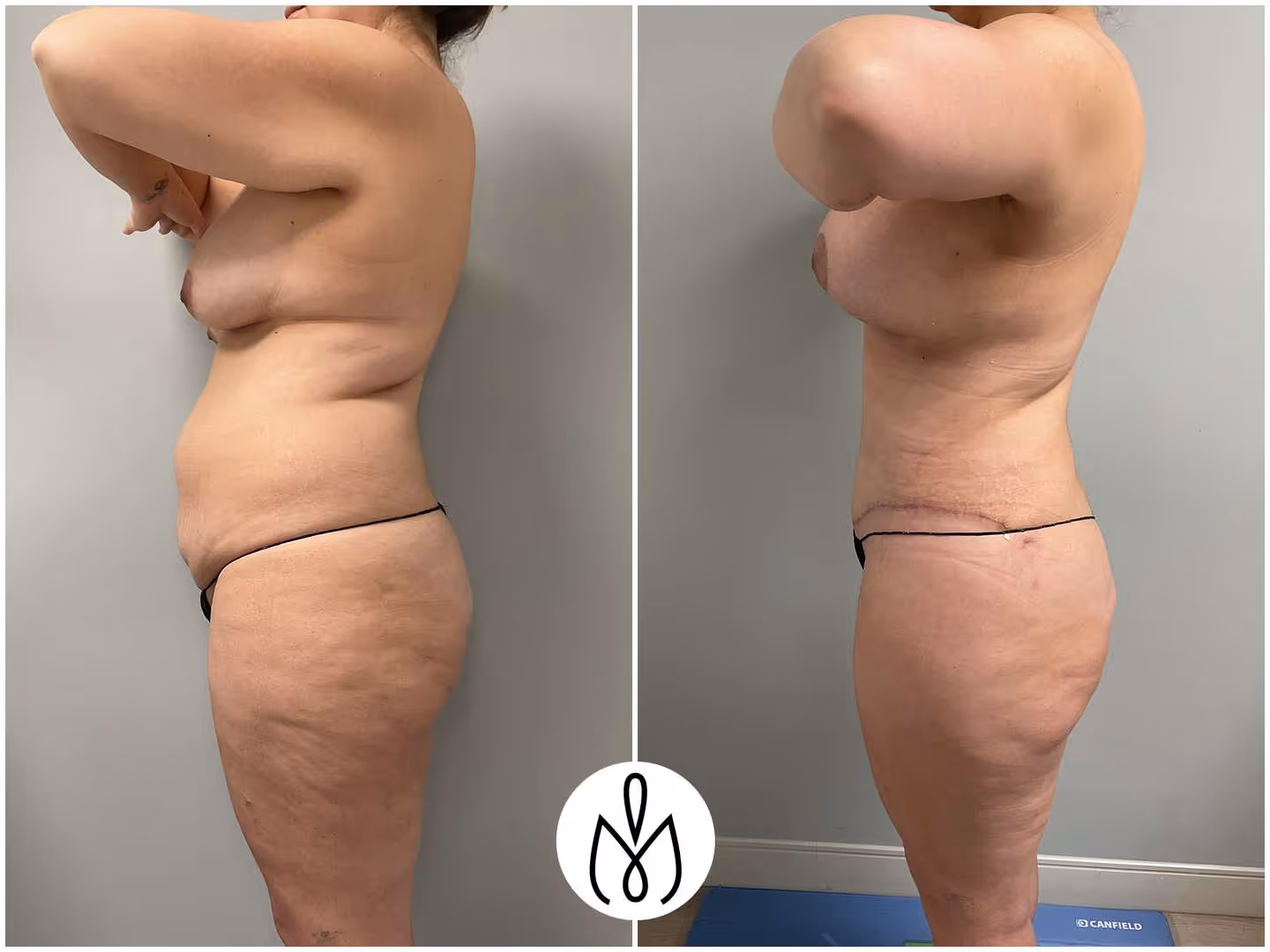 Before,After