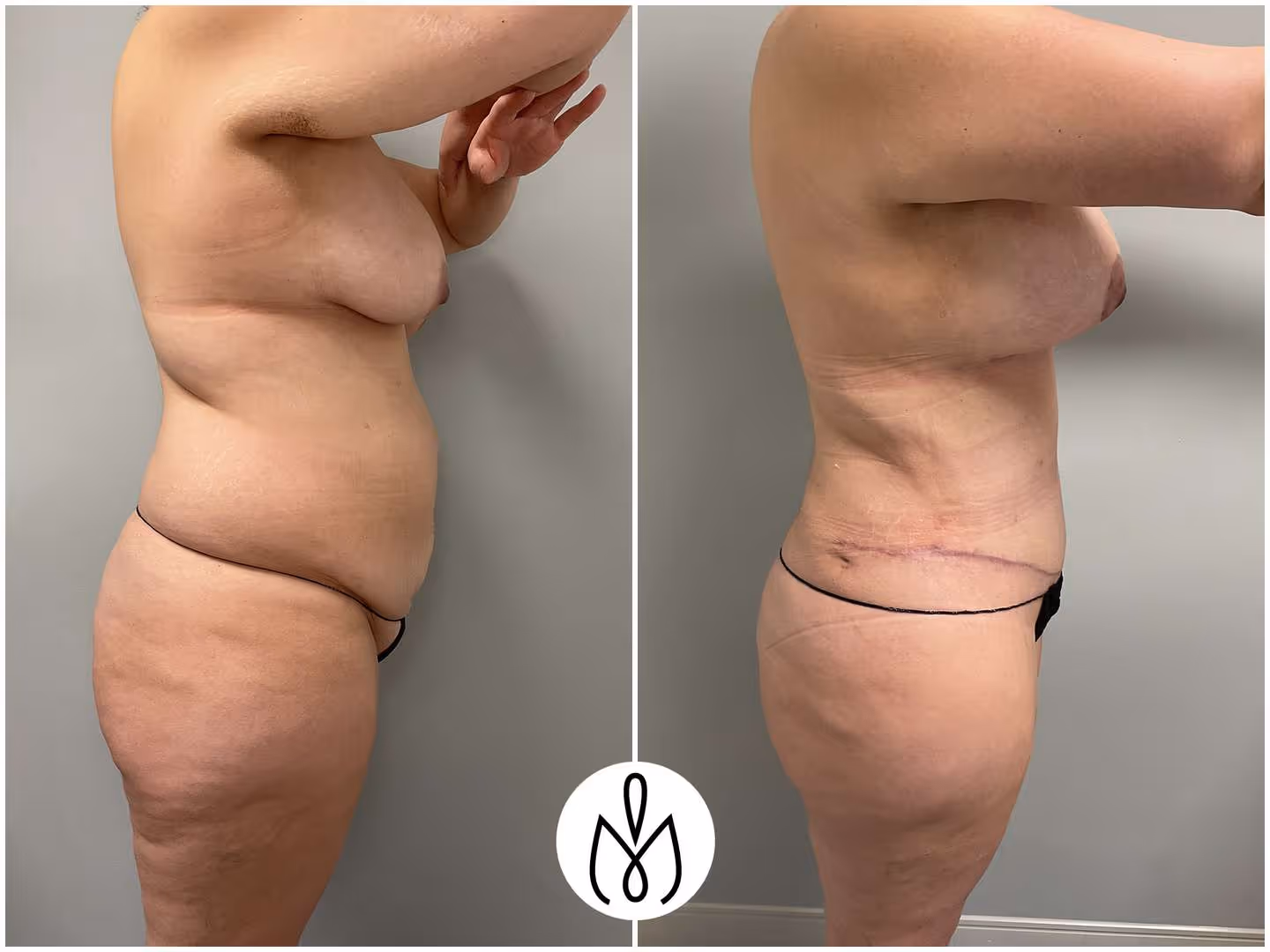 Before,After