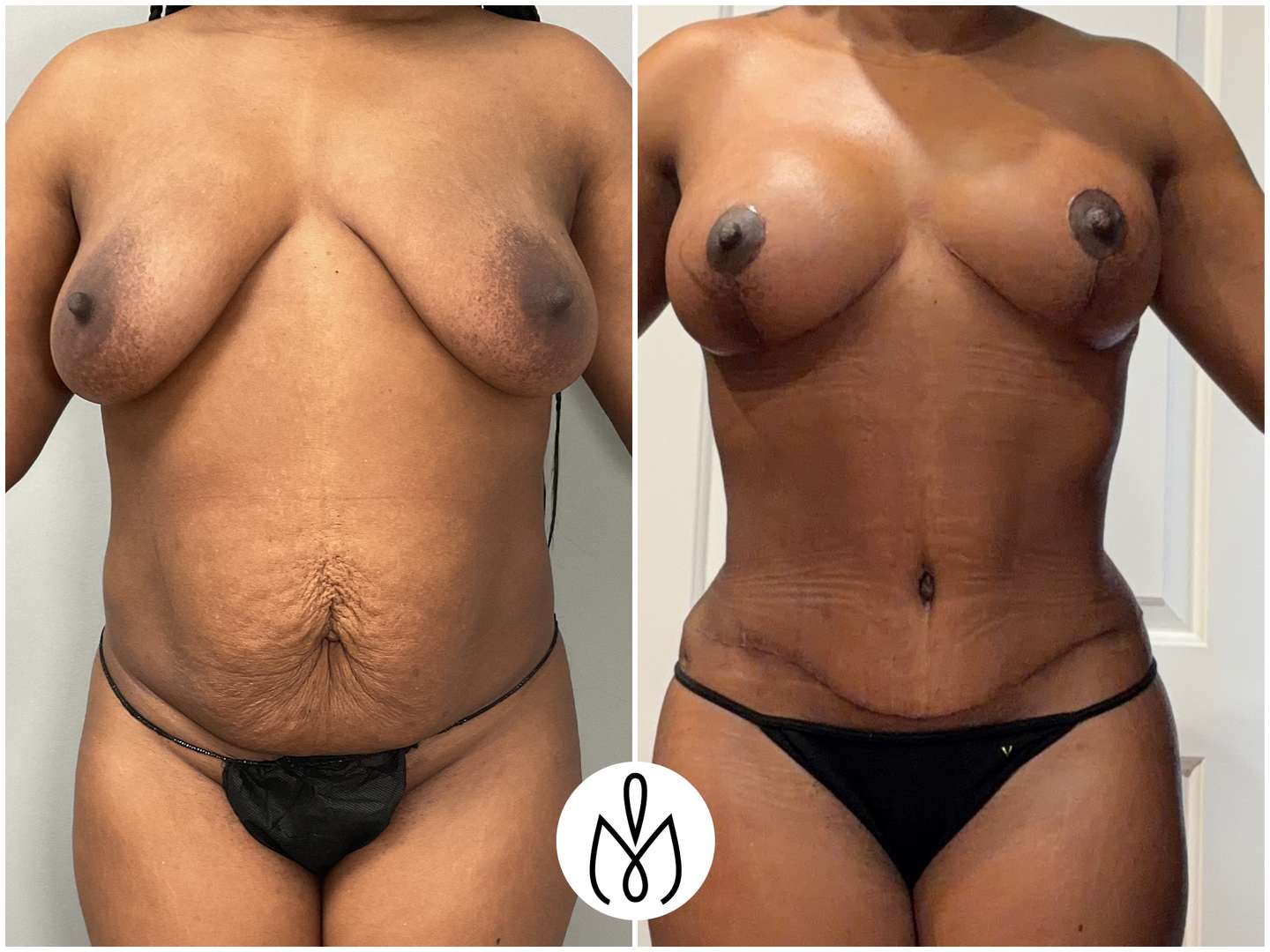 Before,After