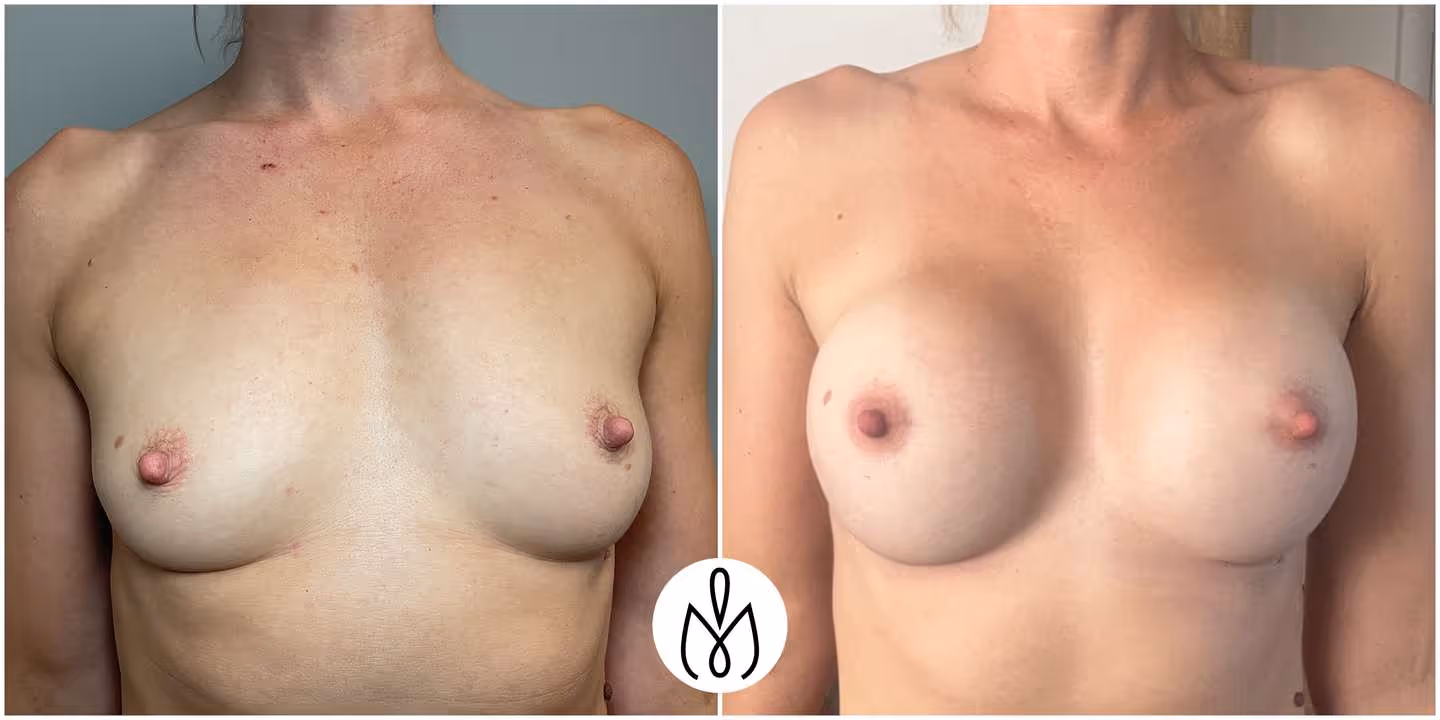 Before,After