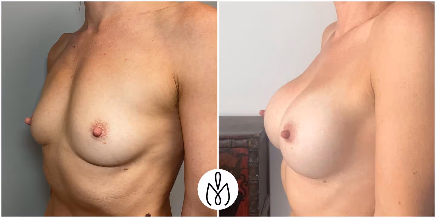 Before,After