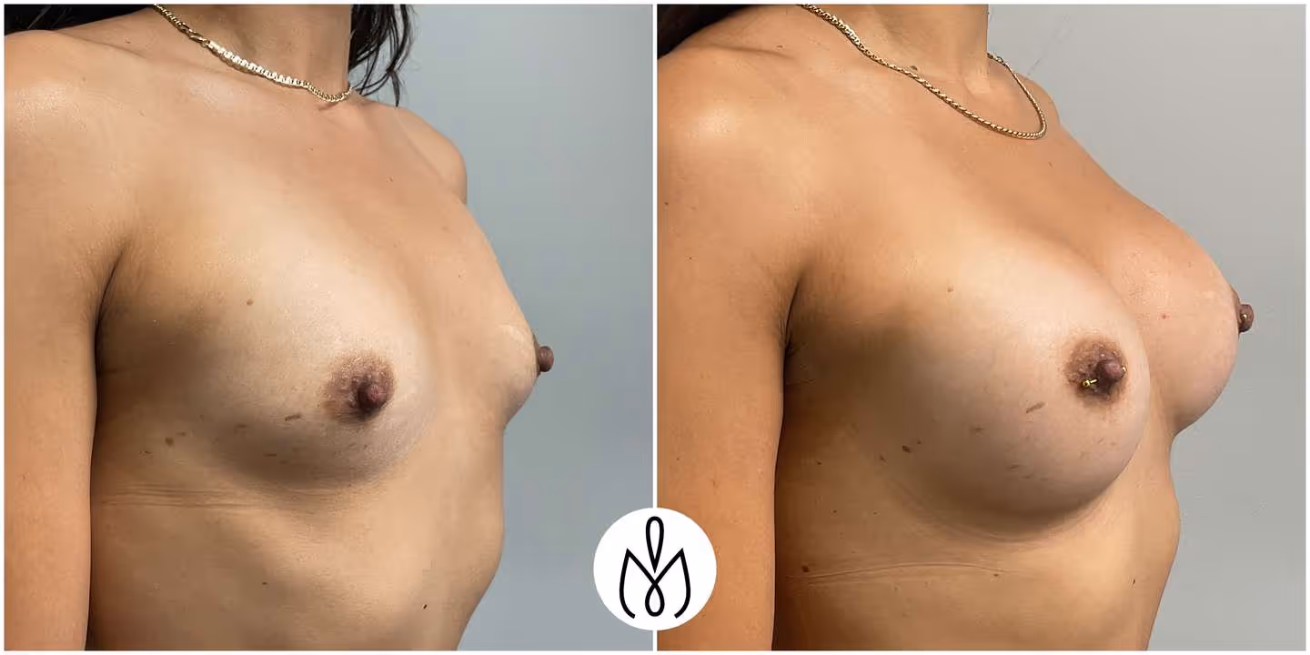 Before,After