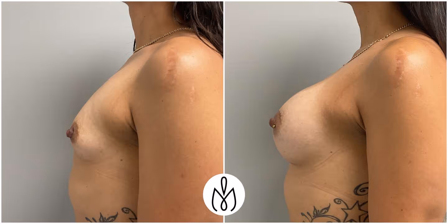 Before,After