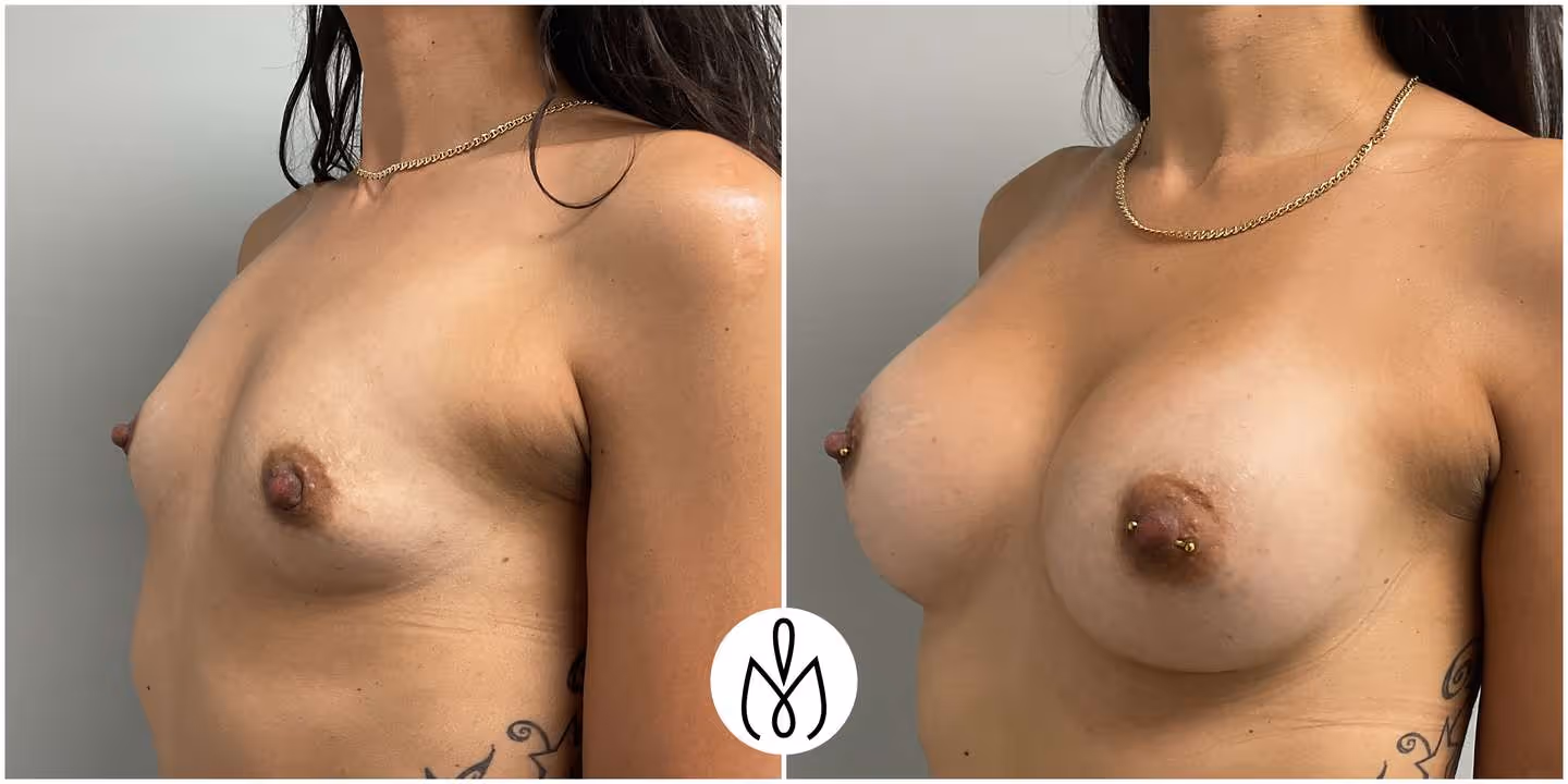 Before,After