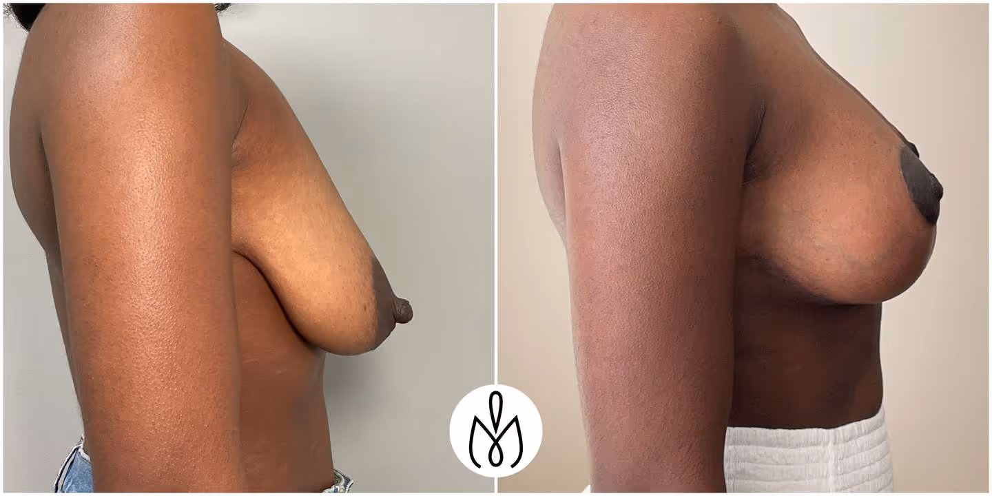 Before,After