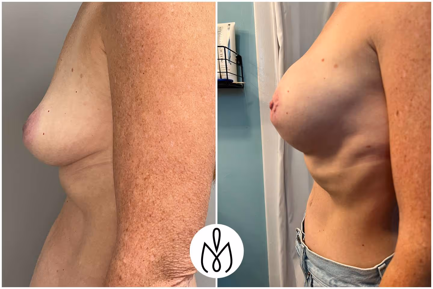 Before,After