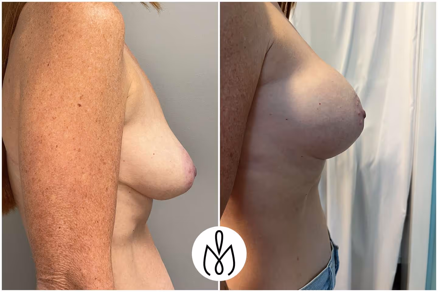 Before,After
