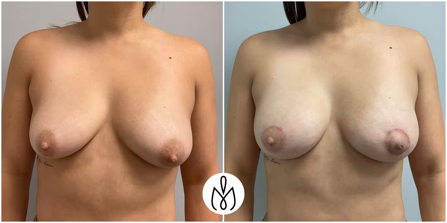 Before,After