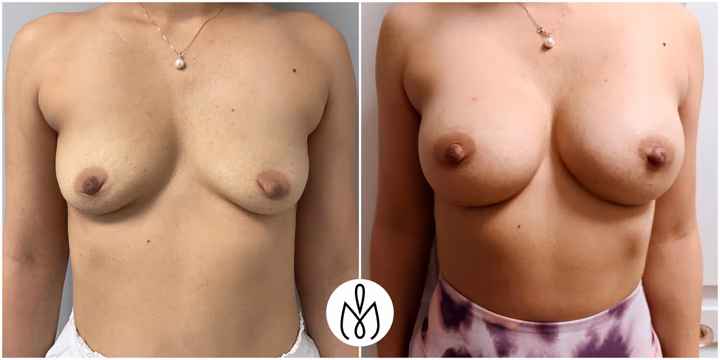 Before,After