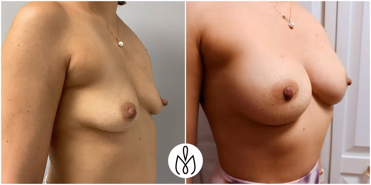 Before,After