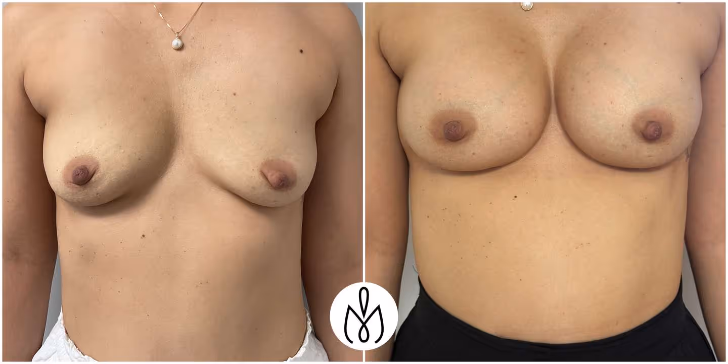 Before,After