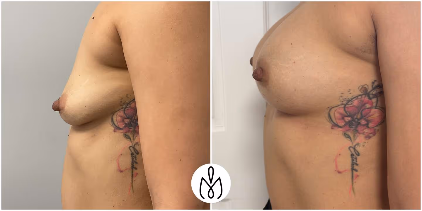 Before,After