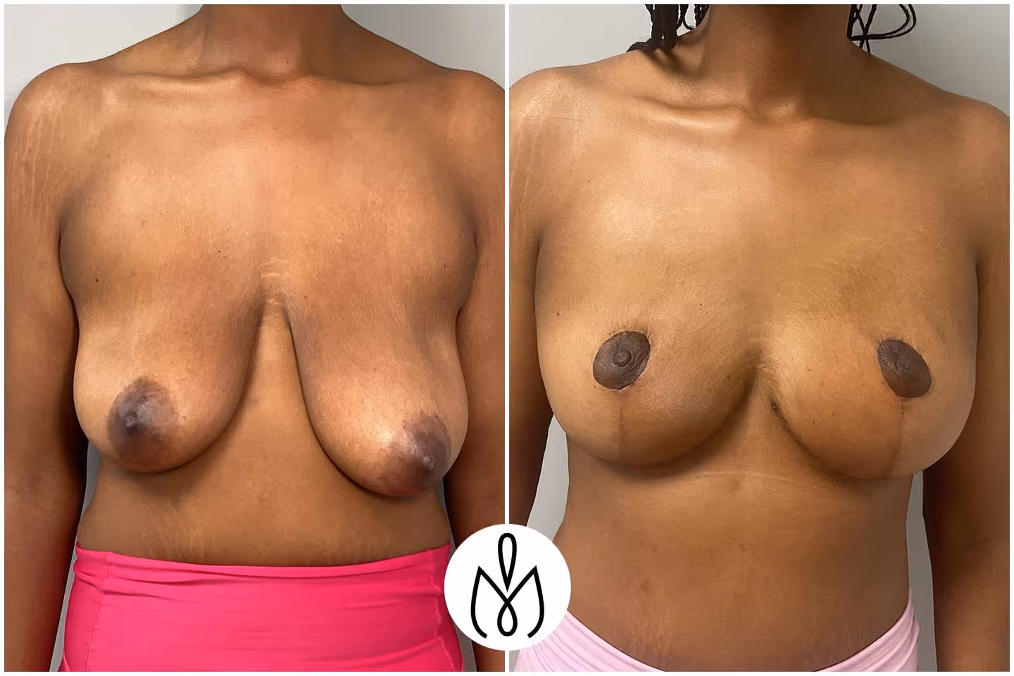 Before,After