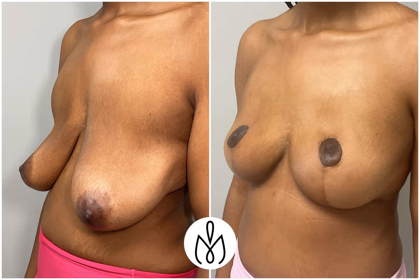 Before,After