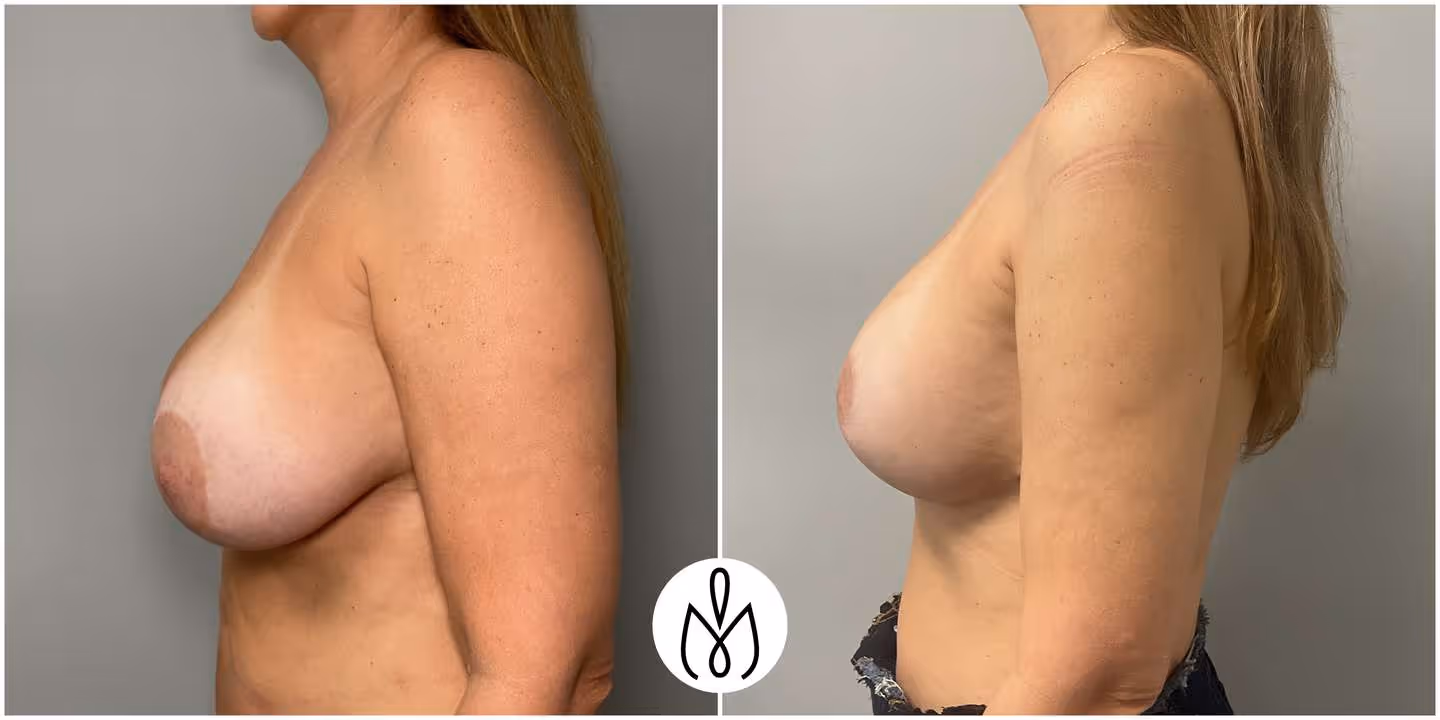 Before,After