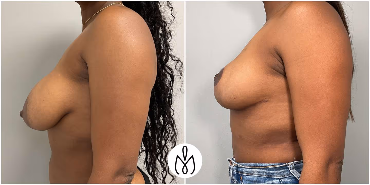 Before,After