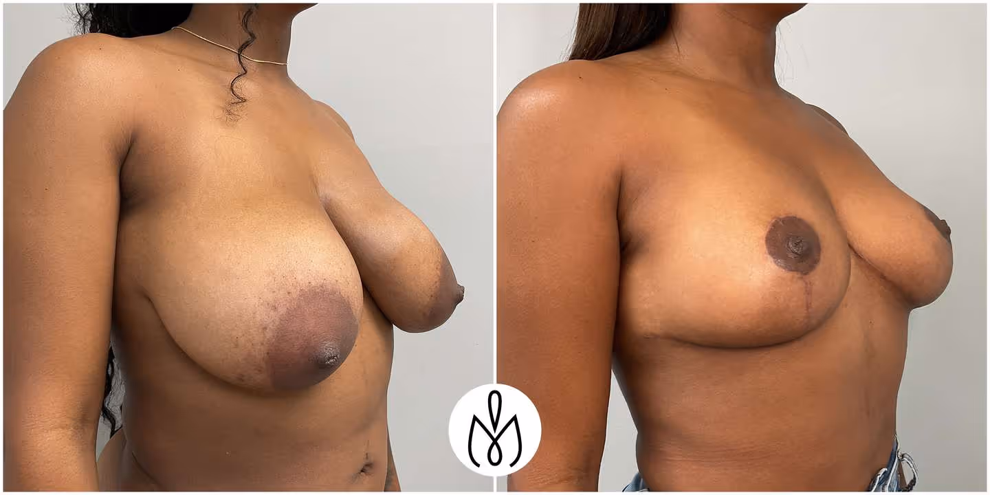 Before,After