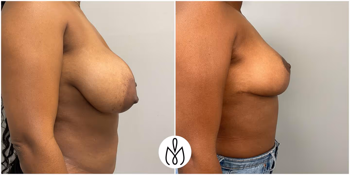 Before,After
