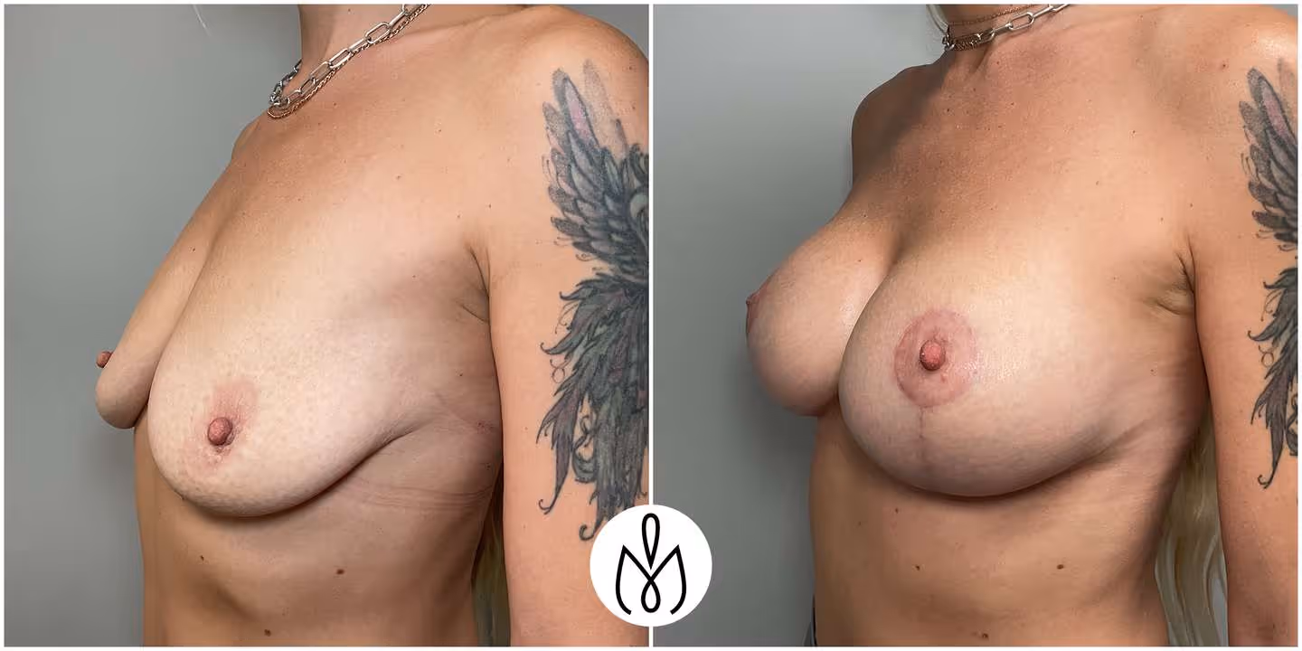 Before,After