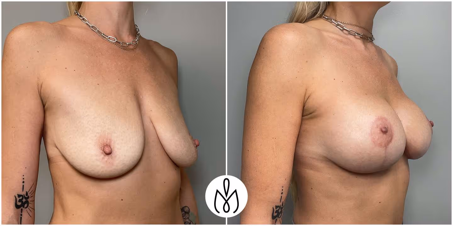 Before,After