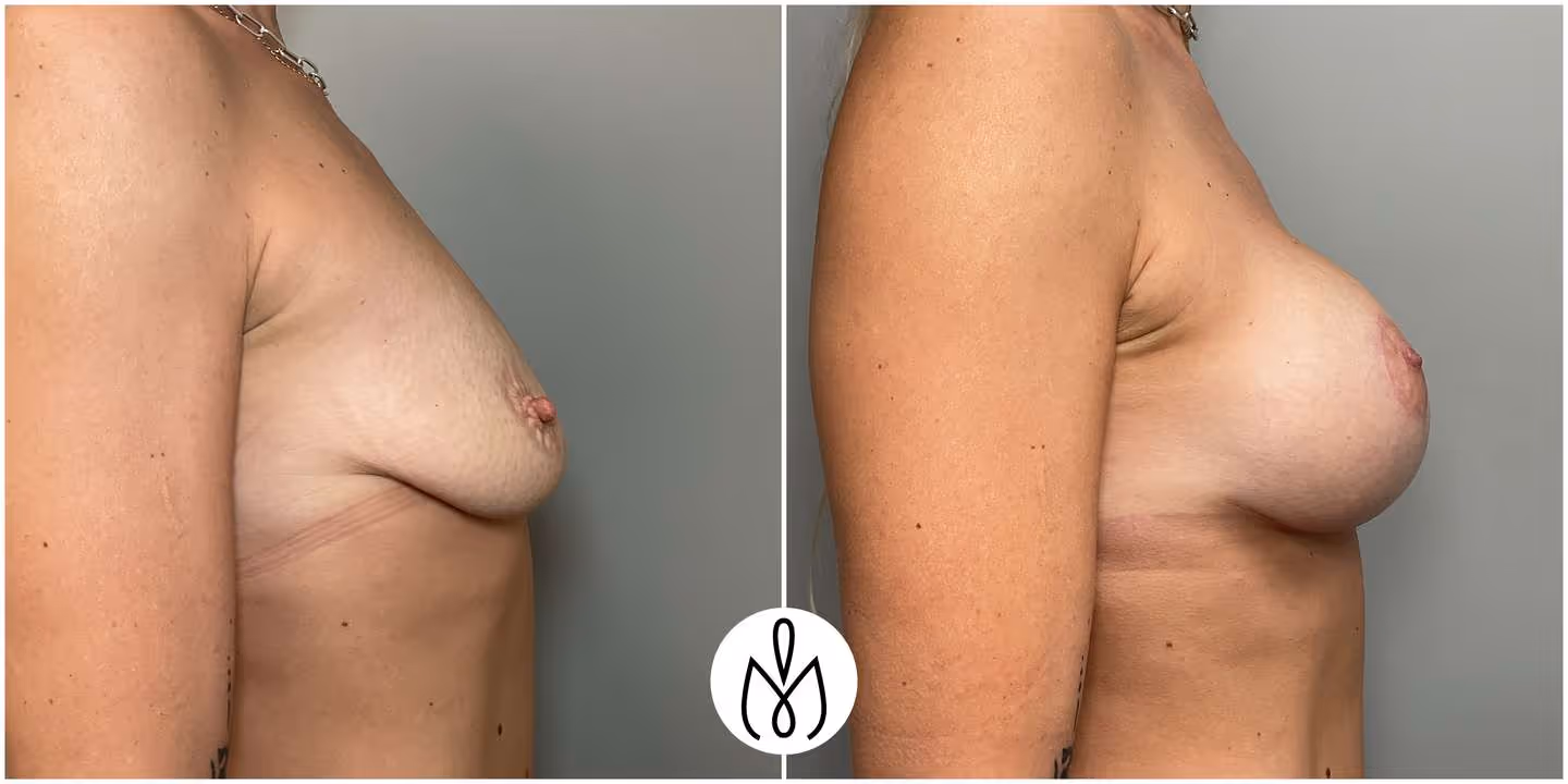 Before,After