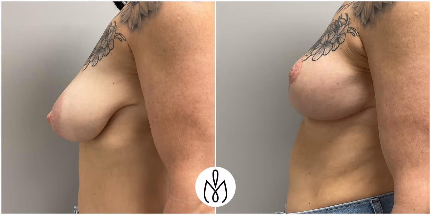 Before,After
