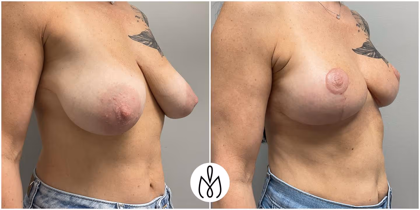 Before,After