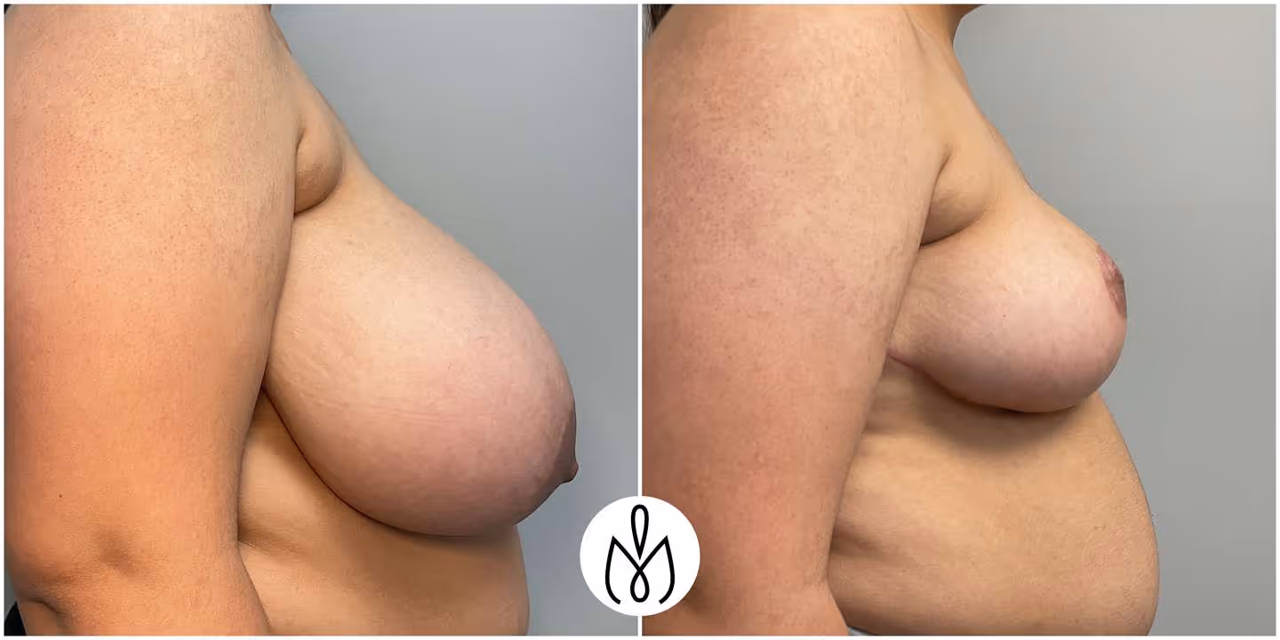 Before,After