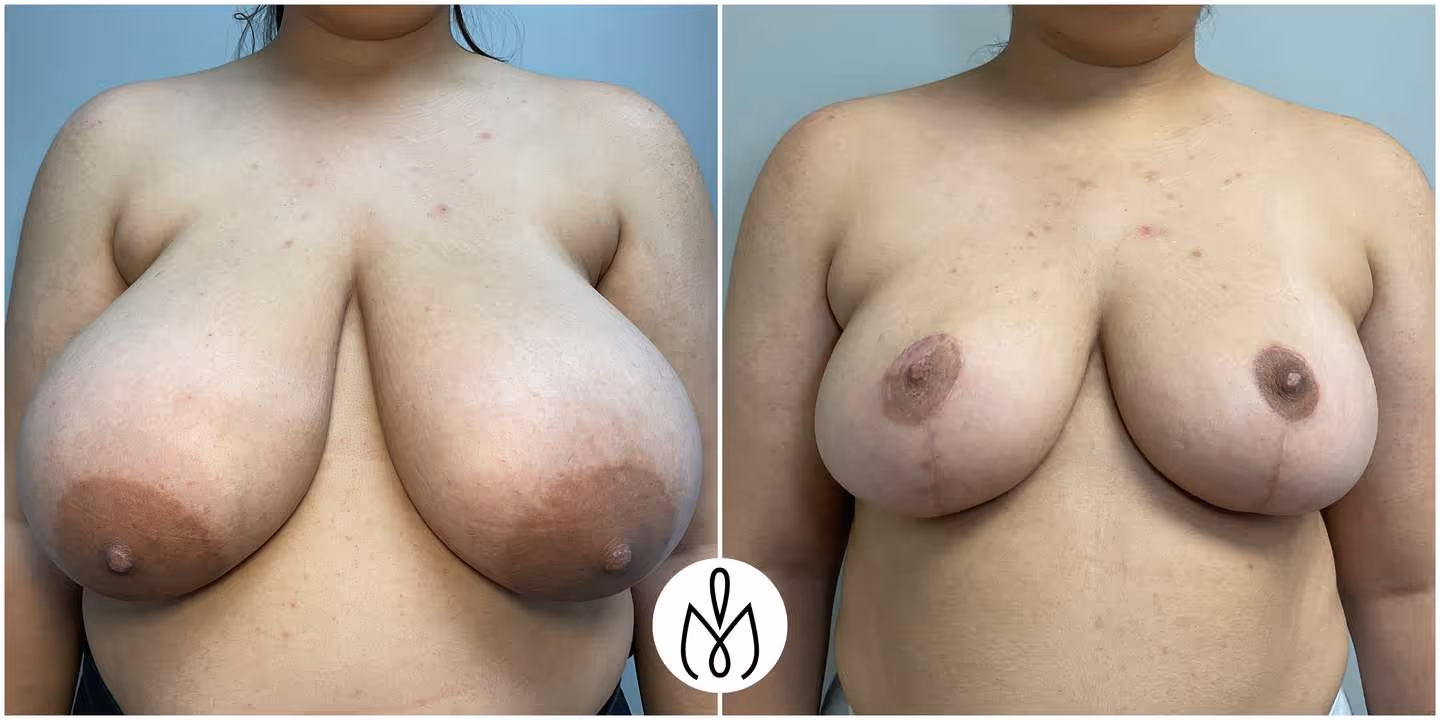 Before,After
