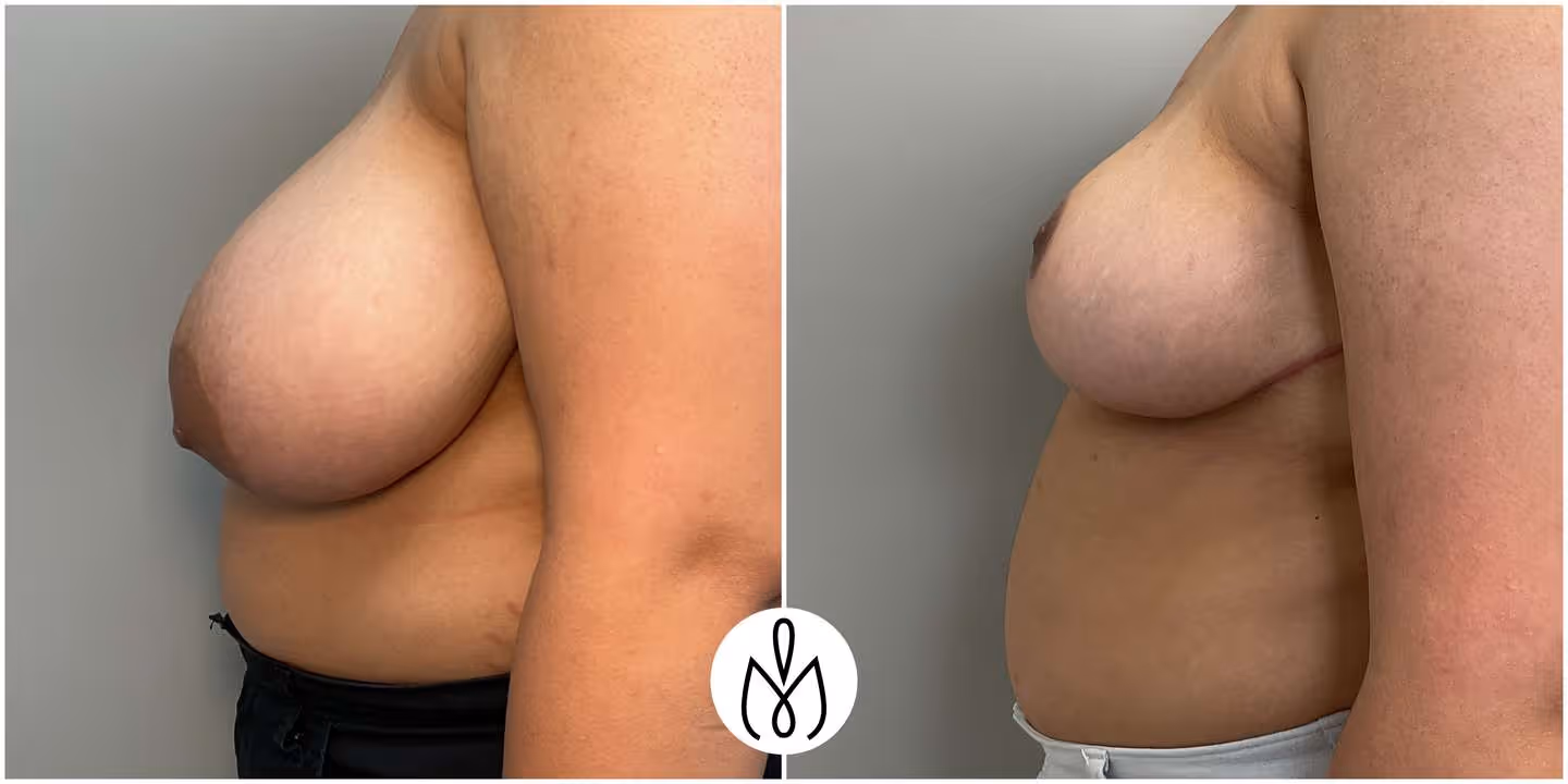 Before,After