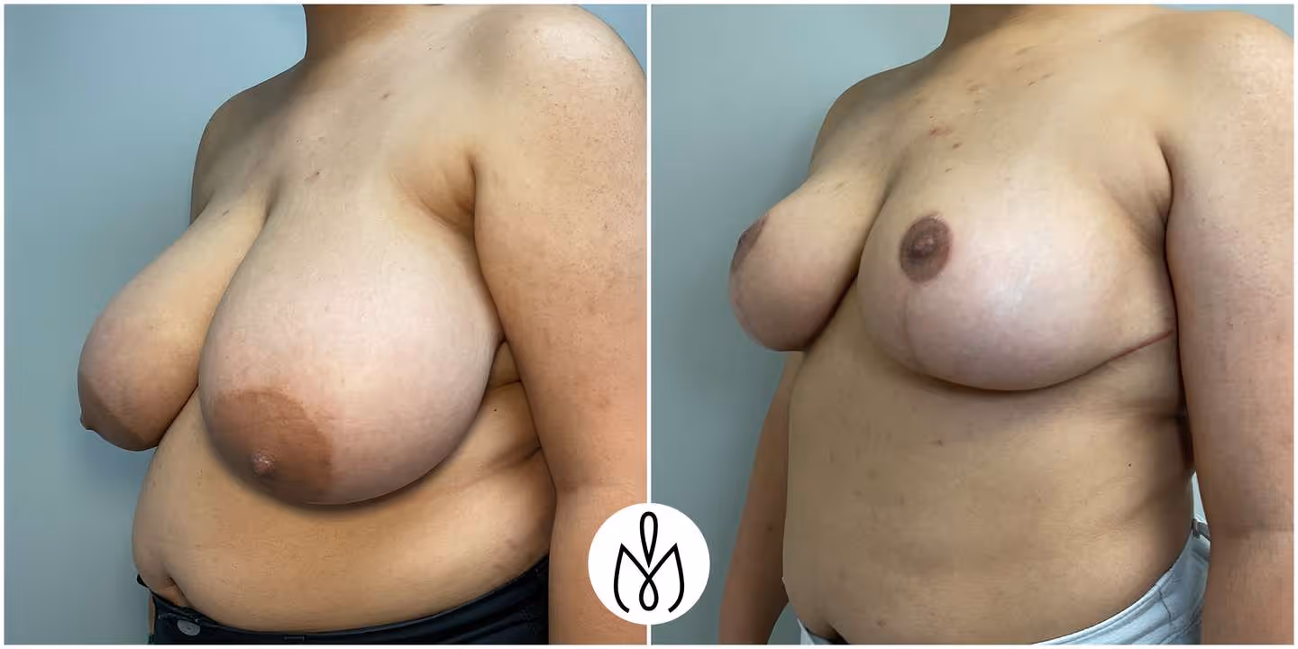 Before,After