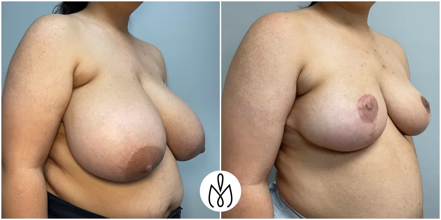 Before,After
