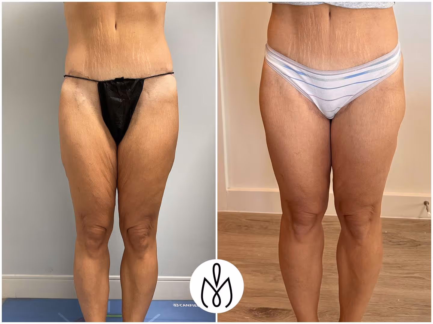 Before,After