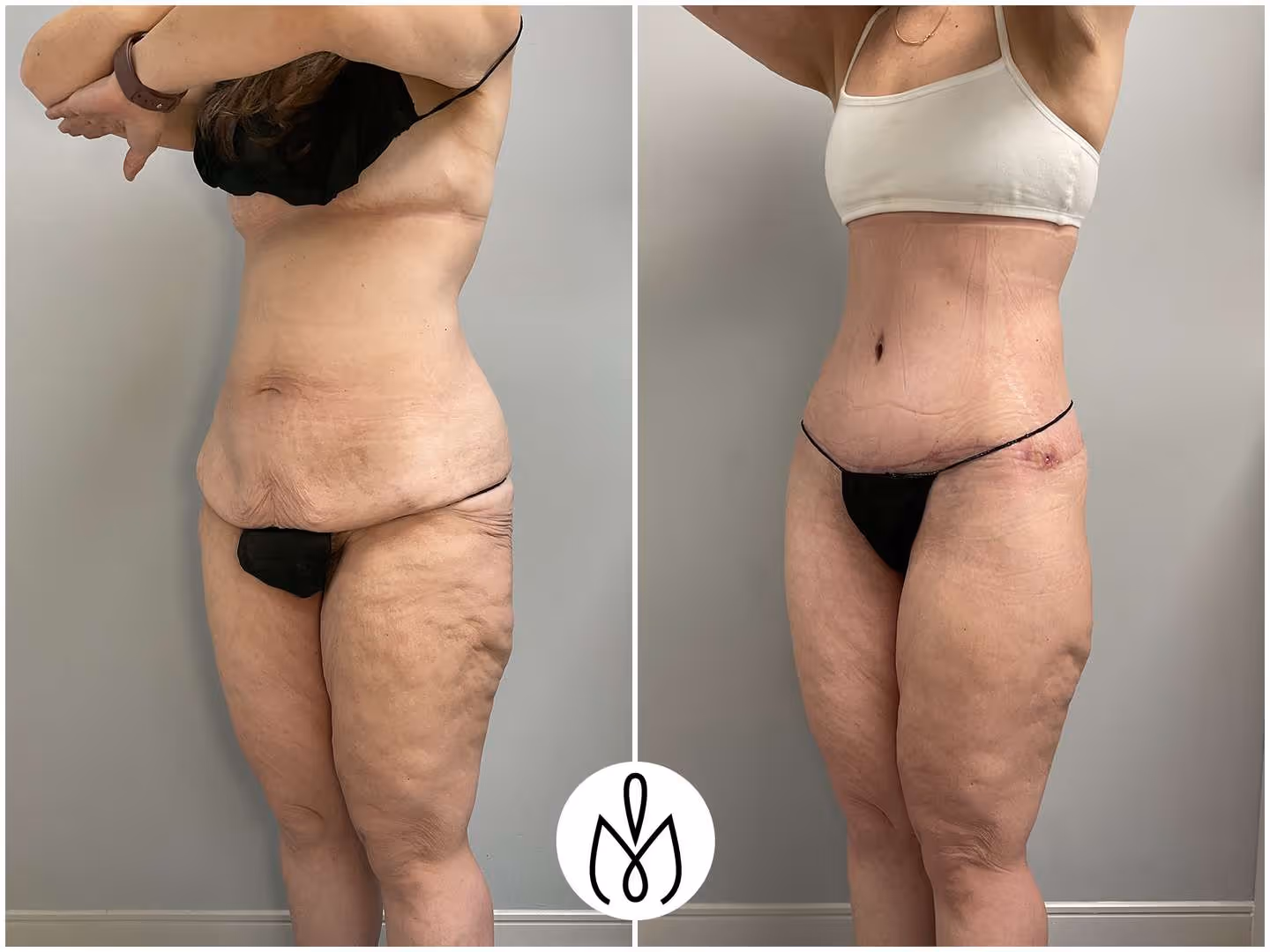 Before,After