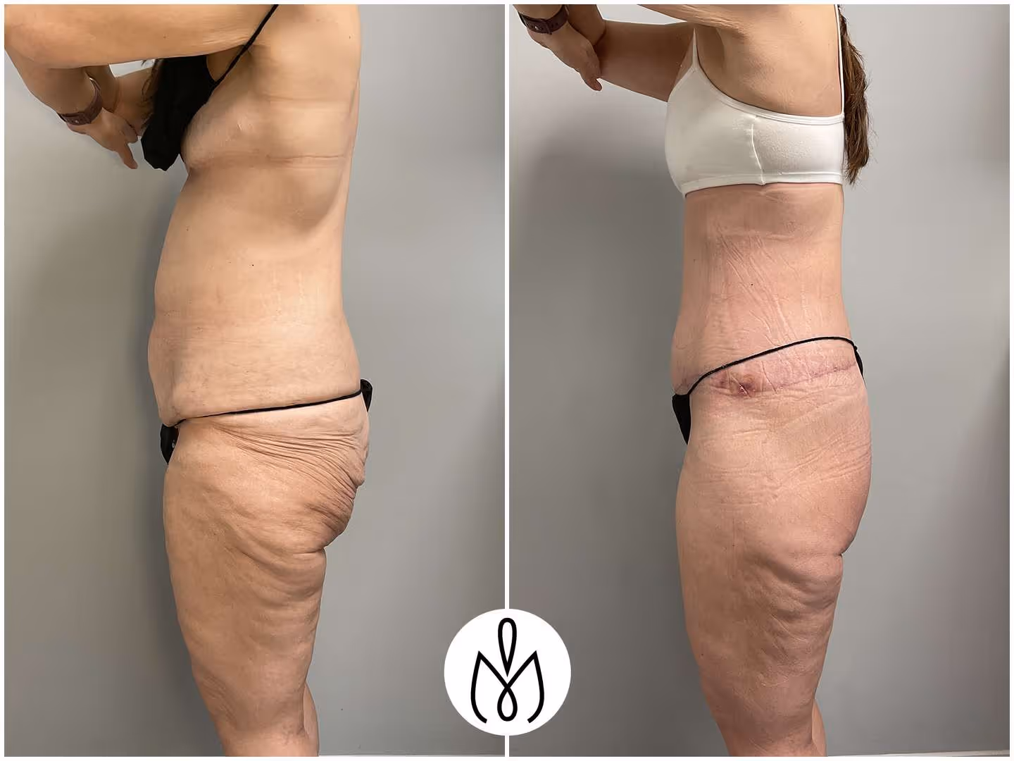 Before,After