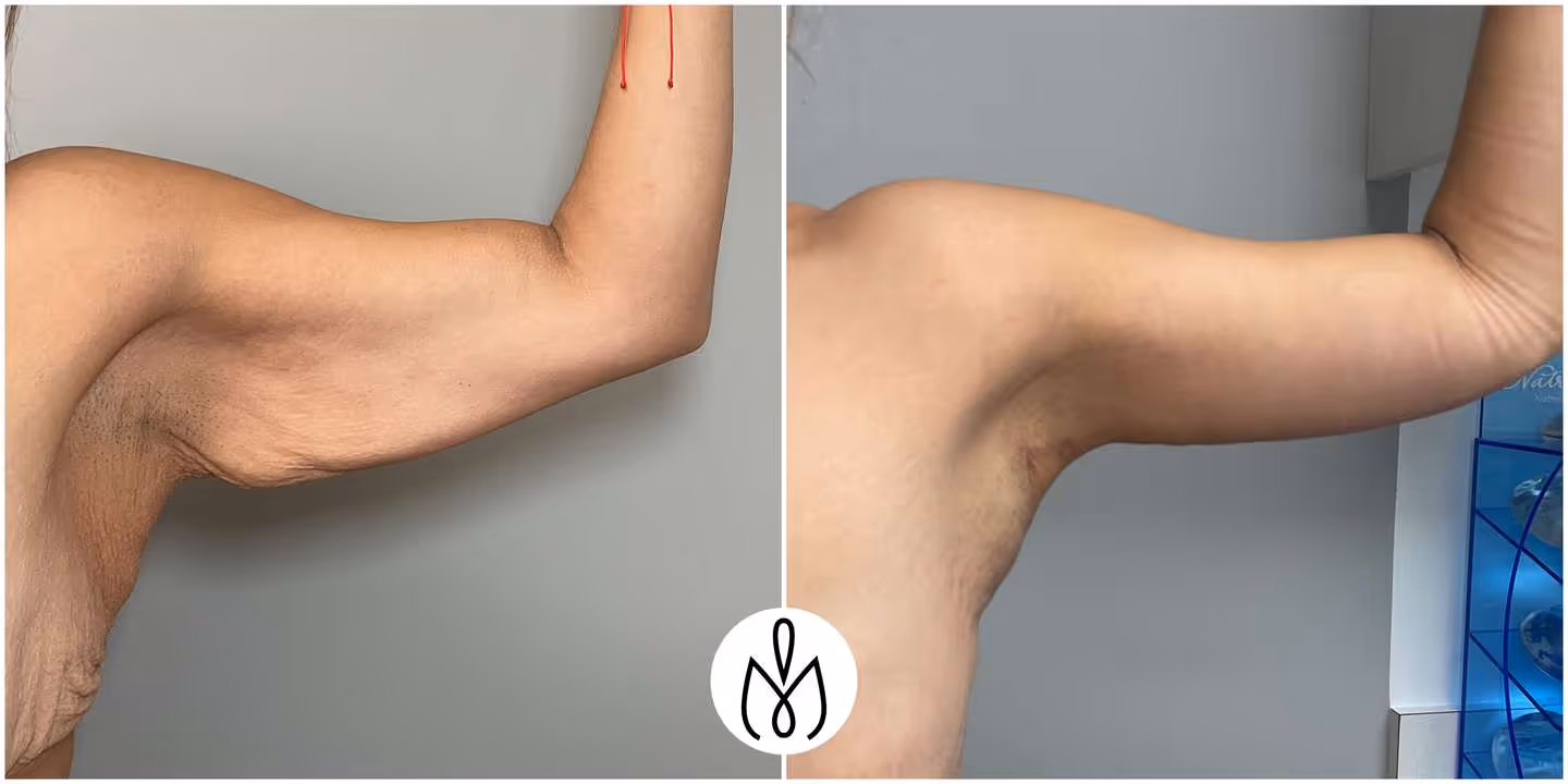 Before,After