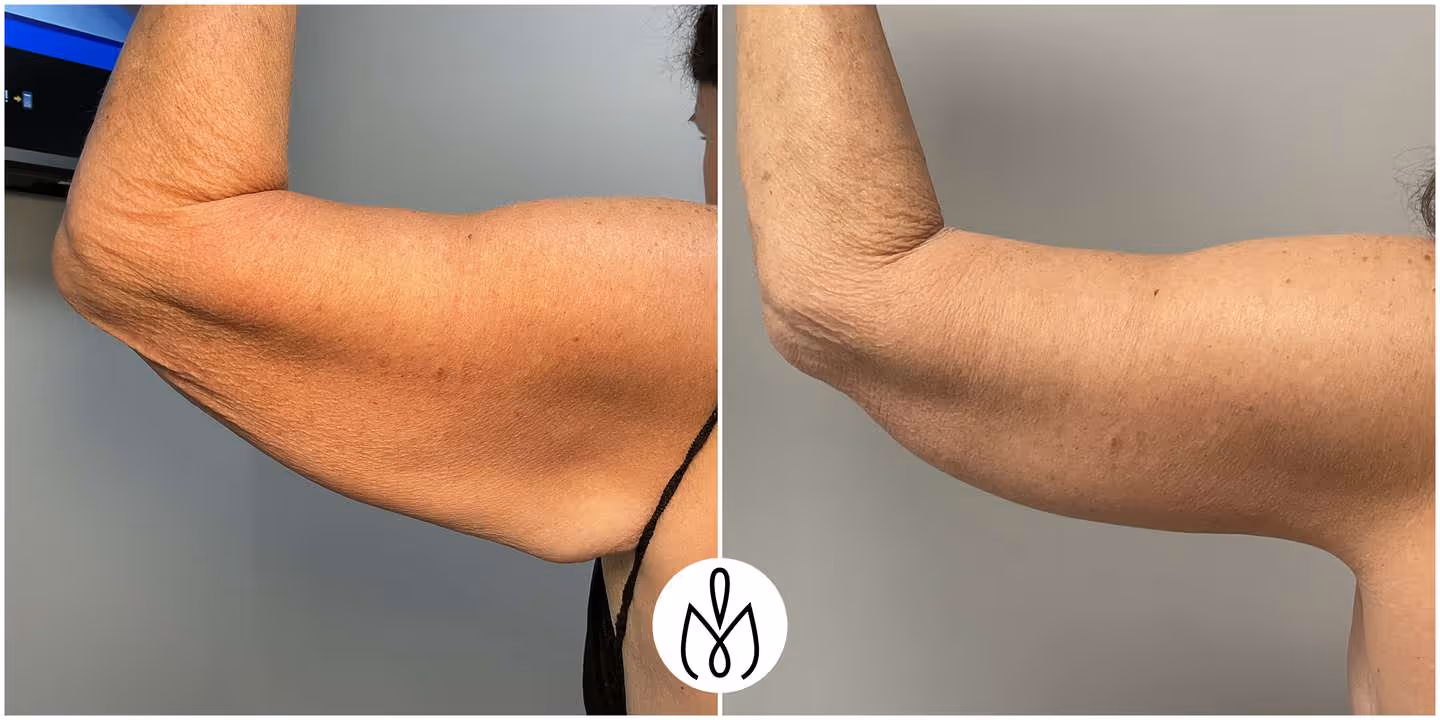 Before,After