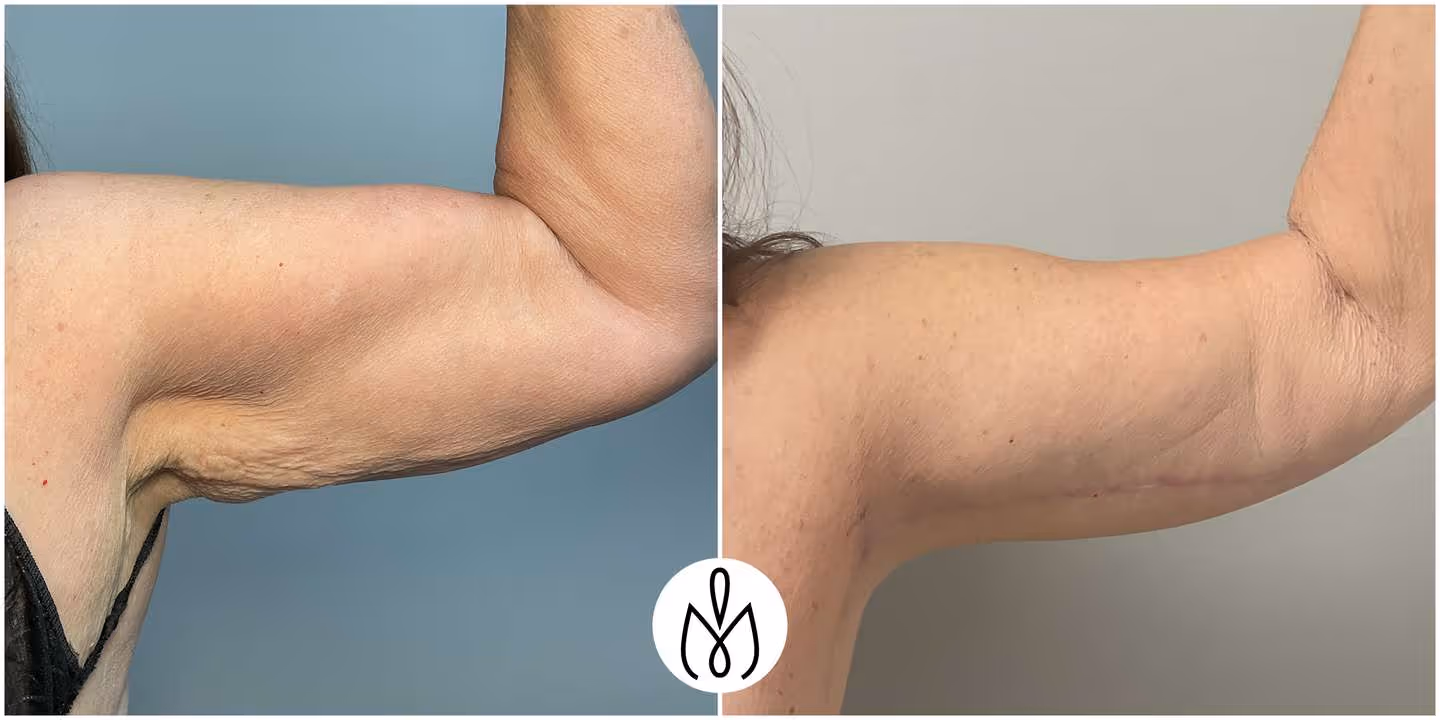 Before,After