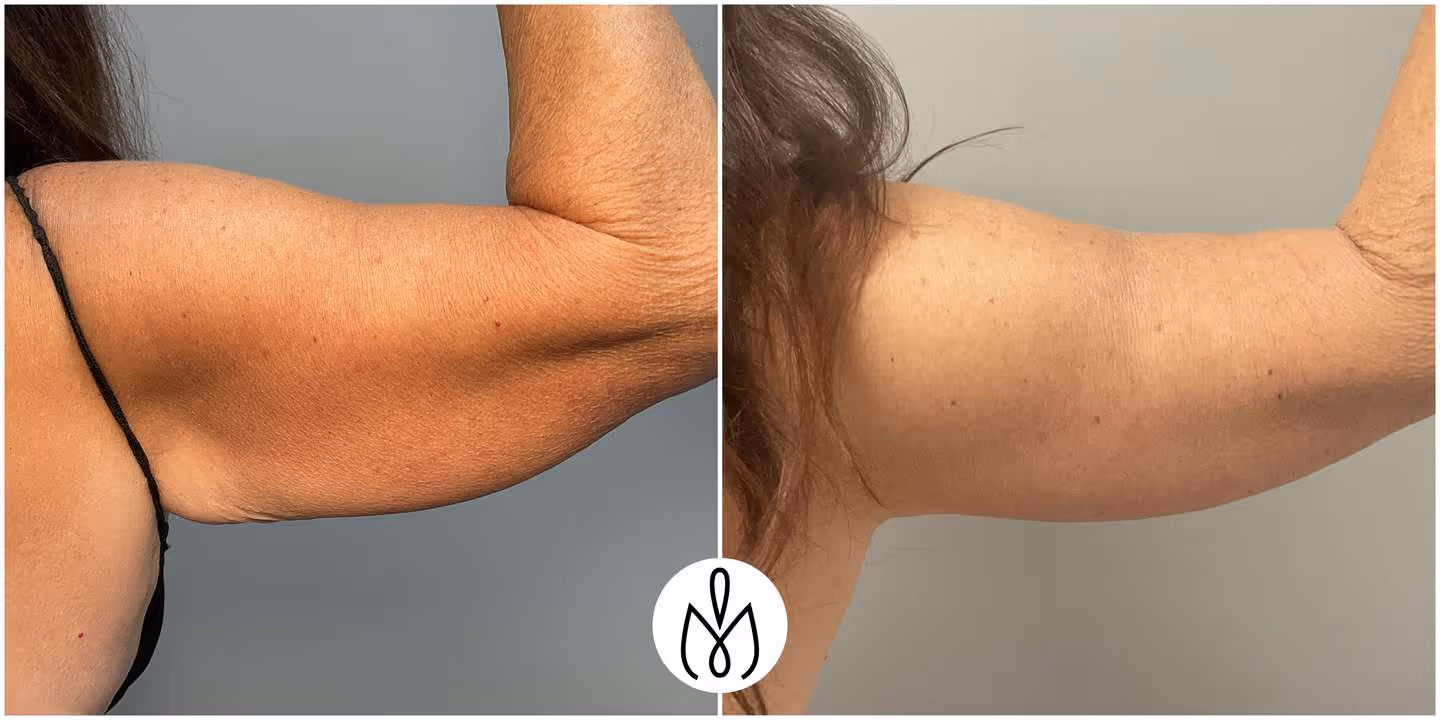 Before,After