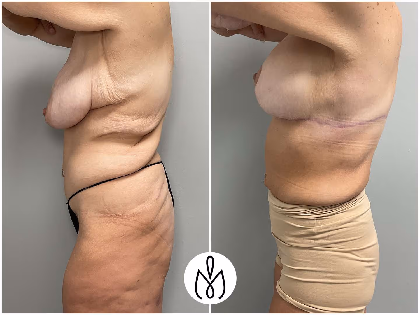 Before,After