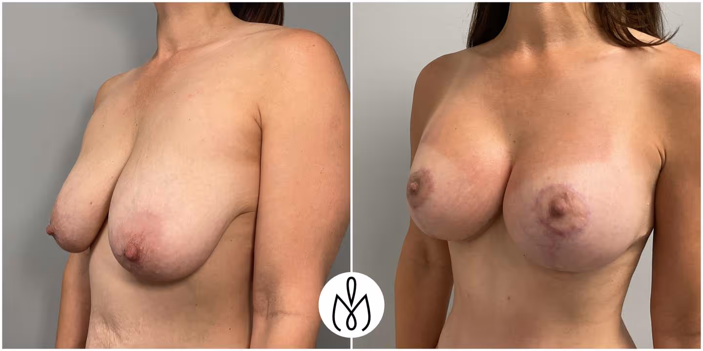 Before,After