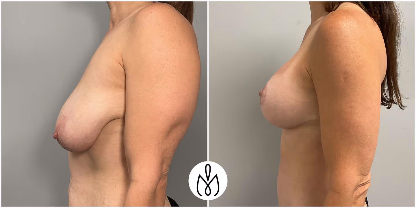Before,After